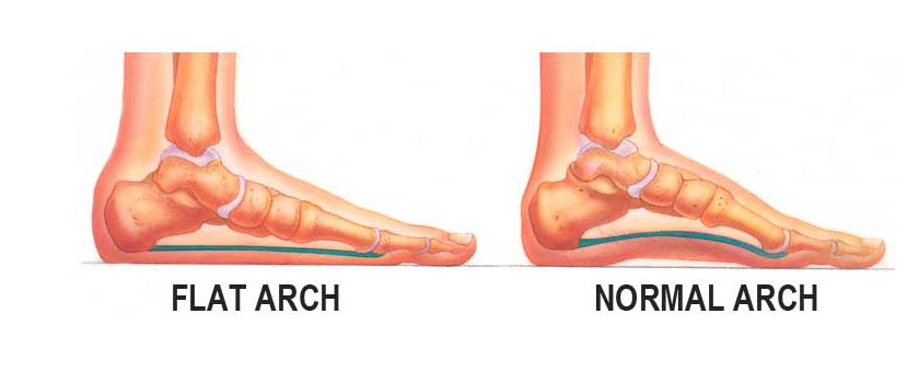 Flat Feet Treatment – California Chiropractic Dubai