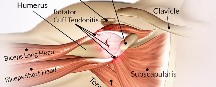cure for rotator cuff pain