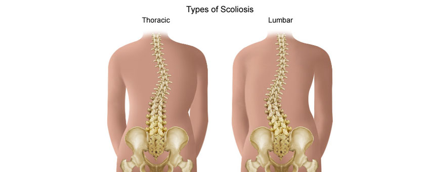 Scoliosis Treatment - California Chiropractic Center - Dubai, Uae